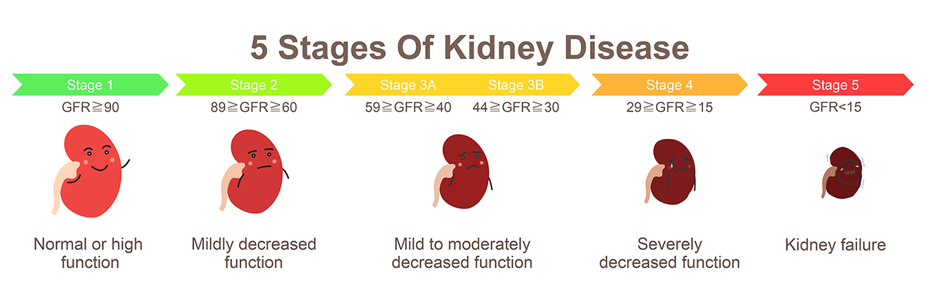 Five kidneys in various stages of chronic kidney disease. As kidney disease progresses from Stage 1 to Stage 5, the kidneys lose function and get smaller. 